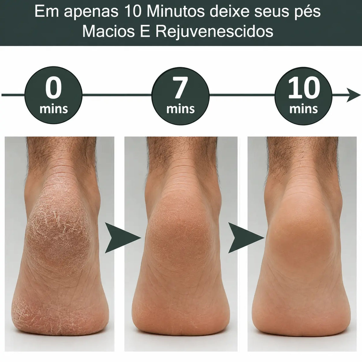 Lixa Eletrica Portátil - Removedor De Calo Para Pés